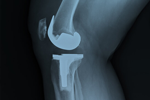 What Is a Total Knee Replacement?